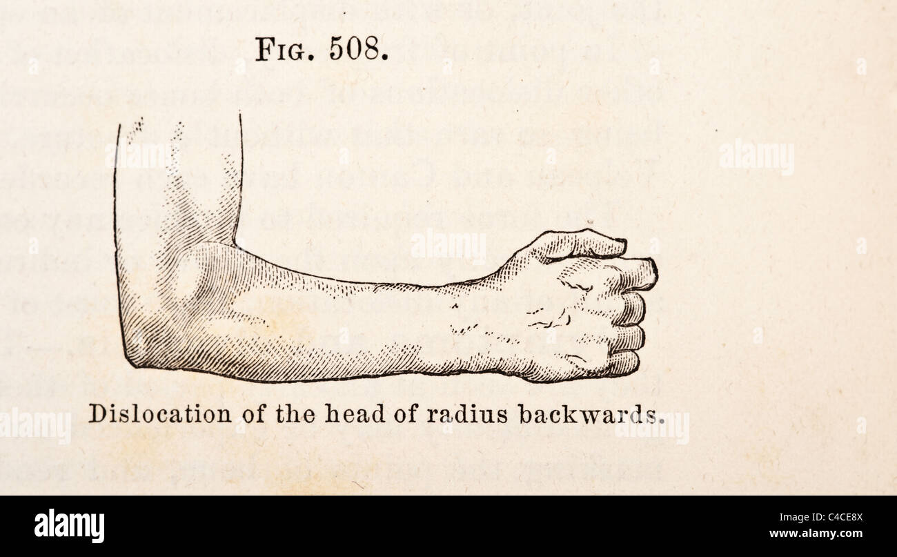 Antike Medizinische Illustration Der Luxation Des Ellenbogens Ca 1881