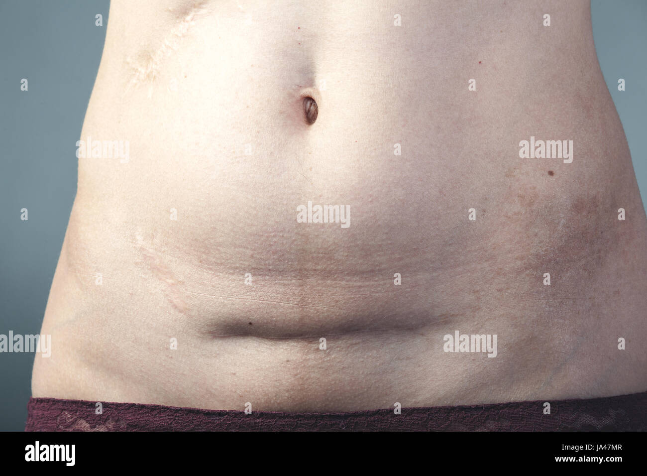 44+ Bauch nach kaiserschnitt bilder , Bauch Kaiserschnitt Narbe auf Frau Bauch Stockfotografie Alamy